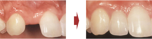 単独歯欠損の症例、インプラント