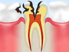C3　中度の虫歯
