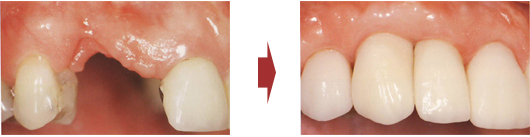 複数歯欠損の症例、インプラント