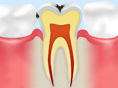 C1　初期の虫歯