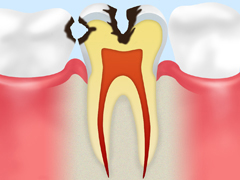 C2　軽度の虫歯