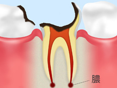 C4　重度の虫歯