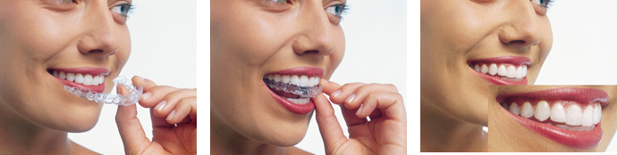 予防歯科で虫歯・歯周病を防ぐ